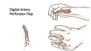 Digital Artery
Perforator Flap
 