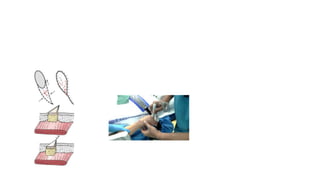 Flap advancement
• Preoperative Doppler
• Outline flap
• Cover the defect
• Donor site closed
directly
 