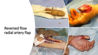 Reversed flow
radial artery flap
 