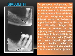 On periapical radiographs, the
radiopacity may be misdiagnosed
as osteosclerosis. To differentiate
an osteosclerosis from a sialolith,
take two radiographs using
different vertical (or horizontal)
angulations of the x-ray beam. If
the radiopacity changes its
position in relation to the
adjoining teeth, as shown here,
the radiopacity is a sialolith in the
floor of the oral cavity (Clark's
rule: same lingual, opposite
buccal). Another method to
identify a submandibular sialolith
is to take an occlusal projection.
SIALOLITH
 