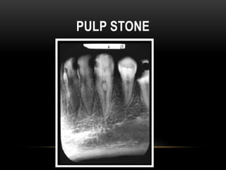 PULP STONE
 