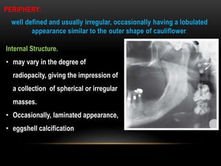 PERIPHERY:
well defined and usually irregular, occasionally having a lobulated
appearance similar to the outer shape of cauliflower.
Internal Structure.
• may vary in the degree of
radiopacity, giving the impression of
a collection of spherical or irregular
masses.
• Occasionally, laminated appearance,
• eggshell calcification
 
