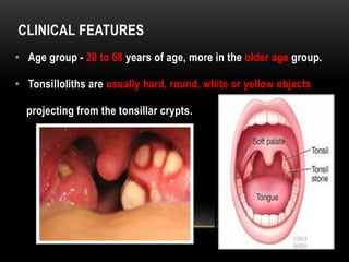 CLINICAL FEATURES
• Age group - 20 to 68 years of age, more in the older age group.
• Tonsilloliths are usually hard, round, white or yellow objects
projecting from the tonsillar crypts.
 