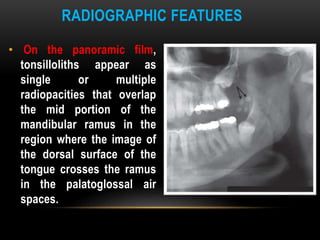 RADIOGRAPHIC FEATURES
• On the panoramic film,
tonsilloliths appear as
single or multiple
radiopacities that overlap
the mid portion of the
mandibular ramus in the
region where the image of
the dorsal surface of the
tongue crosses the ramus
in the palatoglossal air
spaces.
 