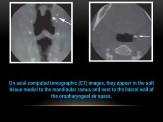 On axial computed tomographic (CT) images, they appear in the soft
tissue medial to the mandibular ramus and next to the lateral wall of
the oropharyngeal air space.
 