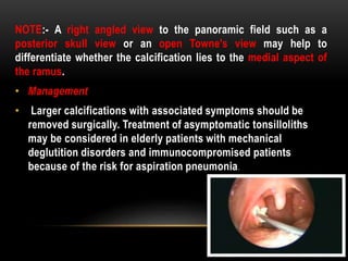 NOTE:- A right angled view to the panoramic field such as a
posterior skull view or an open Towne's view may help to
differentiate whether the calcification lies to the medial aspect of
the ramus.
• Management
• Larger calcifications with associated symptoms should be
removed surgically. Treatment of asymptomatic tonsilloliths
may be considered in elderly patients with mechanical
deglutition disorders and immunocompromised patients
because of the risk for aspiration pneumonia.
 
