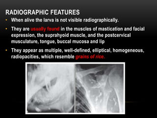 RADIOGRAPHIC FEATURES
• When alive the larva is not visible radiographically.
• They are usually found in the muscles of mastication and facial
expression, the suprahyoid muscle, and the postcervical
musculature, tongue, buccal mucosa and lip
• They appear as multiple, well-defined, elliptical, homogeneous,
radiopacities, which resemble grains of rice.
 