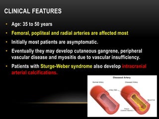 CLINICAL FEATURES
• Age: 35 to 50 years
• Femoral, popliteal and radial arteries are affected most
• Initially most patients are asymptomatic.
• Eventually they may develop cutaneous gangrene, peripheral
vascular disease and myositis due to vascular insufficiency.
• Patients with Sturge-Weber syndrome also develop intracranial
arterial calcifications.
 