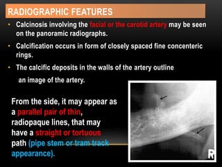 RADIOGRAPHIC FEATURES
• Calcinosis involving the facial or the carotid artery may be seen
on the panoramic radiographs.
• Calcification occurs in form of closely spaced fine concenteric
rings.
• The calcific deposits in the walls of the artery outline
an image of the artery.
From the side, it may appear as
a parallel pair of thin,
radiopaque lines, that may
have a straight or tortuous
path (pipe stem or tram track
appearance).
 