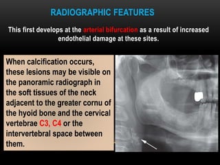 RADIOGRAPHIC FEATURES
This first develops at the arterial bifurcation as a result of increased
endothelial damage at these sites.
When calcification occurs,
these lesions may be visible on
the panoramic radiograph in
the soft tissues of the neck
adjacent to the greater cornu of
the hyoid bone and the cervical
vertebrae C3, C4 or the
intervertebral space between
them.
 