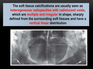 • The soft tissue calcifications are usually seen as
heterogeneous radiopacities with radiolucent voids,
which are multiple and irregular in shape, sharply
defined from the surrounding soft tissues and have a
vertical linear distribution
 