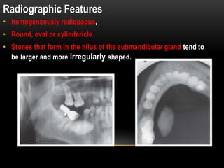 • homogeneously radiopaque,
• Round, oval or cylindericle
• Stones that form in the hilus of the submandibular gland tend to
be larger and more irregularly shaped.
Radiographic Features
 