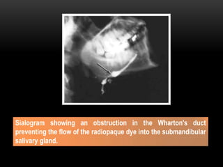 Sialogram showing an obstruction in the Wharton's duct
preventing the flow of the radiopaque dye into the submandibular
salivary gland.
 