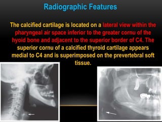 Radiographic Features
The calcified cartilage is located on a lateral view within the
pharyngeal air space inferior to the greater cornu of the
hyoid bone and adjacent to the superior border of C4. The
superior cornu of a calcified thyroid cartilage appears
medial to C4 and is superimposed on the prevertebral soft
tissue.
 