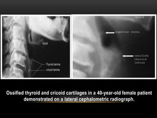 Ossiﬁed thyroid and cricoid cartilages in a 40-year-old female patient
demonstrated on a lateral cephalometric radiograph.
 