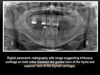 Digital panoramic radiography with image suggesting triticeous
cartilage on both sides (between the greater horn of the hyoid and
superior horn of the thyroid cartilage).
 