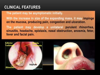 CLINICAL FEATURES
• The patient may be asymptomatic initially.
• With the increase in size of the expanding mass, it may impinge
on the mucosa, producing pain, congestion and ulceration.
• The patient may develop a unilateral purulent rhinorrhea,
sinusitis, headache, epistaxis, nasal obstruction, anosmia, fetor,
fever and facial pain.
 