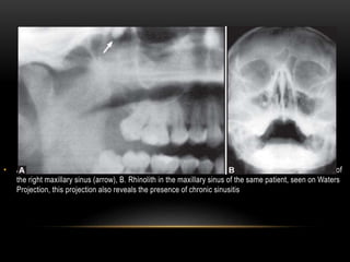 • A. Rhinolith in the maxillary sinus, seen on an OPG. The rhinolith is seen located at the posterior wall of
the right maxillary sinus (arrow), B. Rhinolith in the maxillary sinus of the same patient, seen on Waters
Projection, this projection also reveals the presence of chronic sinusitis
 
