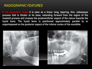 RADIOGRAPHIC FEATURES
In the panoramic image it is seen as a linear, long, tapering, thin, radiopaque
process that is thicker at its base, extending forward from the region of the
mastoid process and crosses the posteroinferior aspect of the ramus towards the
hyoid bone. The hyoid bone is positioned approximately parallel to or
superimposed on the posterior aspect of the inferior cortex of the mandible.
 