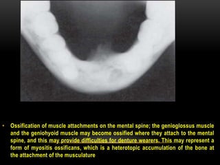 • Ossification of muscle attachments on the mental spine; the genioglossus muscle
and the geniohyoid muscle may become ossified where they attach to the mental
spine, and this may provide difficulties for denture wearers. This may represent a
form of myositis ossificans, which is a heterotopic accumulation of the bone at
the attachment of the musculature
 