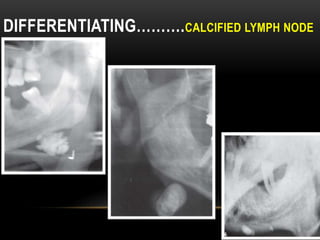 DIFFERENTIATING……….CALCIFIED LYMPH NODE
 