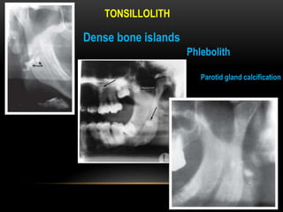 TONSILLOLITH
Dense bone islands
Phlebolith
Parotid gland calcification
 