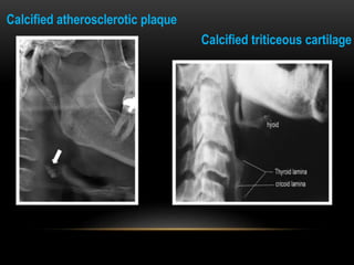 Calcified atherosclerotic plaque
Calcified triticeous cartilage
 
