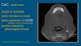 Reference: Metrowestdentalgroup.com
CAC: axial view
single or multiple
semi-circular or ovoid
latero-posterior to GCHB
(greater cornu of hyoid bone)
postero-lateral to
pharyngeal airway
 