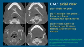 CAC: axial view
(a) as single rice grain
(b), (c) multiple "rice grains",
linear, curvilinear
homogeneous opacifications
(d) increased number of
ipsilateral opacifications,
forming larger coalescing
masses
Soft Tissue Calcifications In The Neck: Maxillofacial CBCT Presentation And Significance
Dr. William C. Scarfe BDS, FRACDS, MS, Dr. Allan G. Farman BDS, PhD, MBA, DSc
Dept. of Surgical/Hospital Dentistry, University of Louisville School of Dentistry
Louisville, Kentucky
From the Spring 2010 AADMRT Newsletter
 