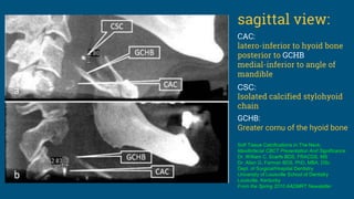 sagittal view:
CAC:
latero-inferior to hyoid bone
posterior to GCHB
medial-inferior to angle of
mandible
CSC:
Isolated calcified stylohyoid
chain
GCHB:
Greater cornu of the hyoid bone
Soft Tissue Calcifications In The Neck:
Maxillofacial CBCT Presentation And Significance
Dr. William C. Scarfe BDS, FRACDS, MS
Dr. Allan G. Farman BDS, PhD, MBA, DSc
Dept. of Surgical/Hospital Dentistry
University of Louisville School of Dentistry
Louisville, Kentucky
From the Spring 2010 AADMRT Newsletter
 