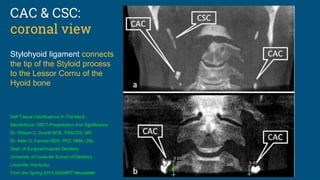 Soft Tissue Calcifications In The Neck:
Maxillofacial CBCT Presentation And Significance
Dr. William C. Scarfe BDS, FRACDS, MS
Dr. Allan G. Farman BDS, PhD, MBA, DSc
Dept. of Surgical/Hospital Dentistry
University of Louisville School of Dentistry
Louisville, Kentucky
From the Spring 2010 AADMRT Newsletter
CAC & CSC:
coronal view
Stylohyoid ligament connects
the tip of the Styloid process
to the Lessor Cornu of the
Hyoid bone
 