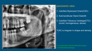 Dr. Douglas K Benn DDS PhD DDR (RCR, England)
Oral & Maxillofacial Radiologist
panoramic view:
1. Calcified Stylohyoid Chain(CSC)
2. Submandibular Gland Sialolith
3. Calcified Triticeous Cartilage(CTC)
(ovoid, homogeneous, dense)
*CAC is irregular in shape and density.
 