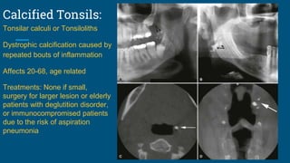 Calcified Tonsils:
Tonsilar calculi or Tonsiloliths
Dystrophic calcification caused by
repeated bouts of inflammation
Affects 20-68, age related
Treatments: None if small,
surgery for larger lesion or elderly
patients with deglutition disorder,
or immunocompromised patients
due to the risk of aspiration
pneumonia
 