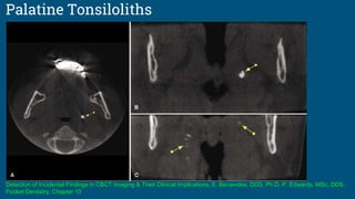 Palatine Tonsiloliths
Detection of Incidental Findings in CBCT Imaging & Their Clinical Implications, E. Benavides, DDS, Ph.D, P. Edwards, MSc, DDS,
Pocket Dentistry, Chapter 10
 