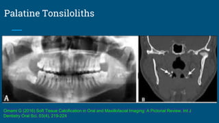 Palatine Tonsiloliths
Omami G (2016) Soft Tissue Calcification in Oral and Maxillofacial Imaging: A Pictorial Review. Int J
Dentistry Oral Sci. 03(4), 219-224
 