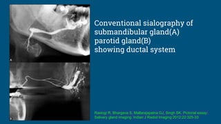 Conventional sialography of
submandibular gland(A)
parotid gland(B)
showing ductal system
Rastogi R, Bhargava S, Mallarajapatna GJ, Singh SK. Pictorial essay:
Salivary gland imaging. Indian J Radiol Imaging 2012;22:325-33
 
