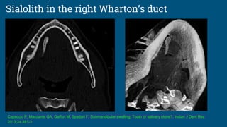 Sialolith in the right Wharton’s duct
Capaccio P, Marciante GA, Gaffuri M, Spadari F. Submandibular swelling: Tooth or salivary stone?. Indian J Dent Res
2013;24:381-3
 