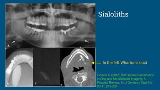 Sialoliths
In the left Wharton’s duct
Omami G (2016) Soft Tissue Calcification
in Oral and Maxillofacial Imaging: A
Pictorial Review. Int J Dentistry Oral Sci.
03(4), 219-224
 