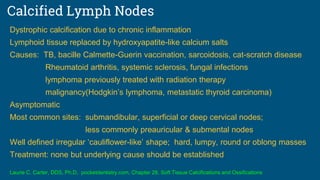 Calcified Lymph Nodes
Dystrophic calcification due to chronic inflammation
Lymphoid tissue replaced by hydroxyapatite-like calcium salts
Causes: TB, bacille Calmette-Guerin vaccination, sarcoidosis, cat-scratch disease
Rheumatoid arthritis, systemic sclerosis, fungal infections
lymphoma previously treated with radiation therapy
malignancy(Hodgkin’s lymphoma, metastatic thyroid carcinoma)
Asymptomatic
Most common sites: submandibular, superficial or deep cervical nodes;
less commonly preauricular & submental nodes
Well defined irregular ‘cauliflower-like’ shape; hard, lumpy, round or oblong masses
Treatment: none but underlying cause should be established
Laurie C. Carter, DDS, Ph.D, pocketdentistry.com, Chapter 28, Soft Tissue Calcifications and Ossifications
 