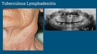 Tuberculous Lymphadenitis
 