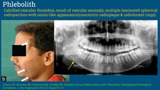 Phlebolith
Calcified vascular thrombus, result of vascular anomaly, multiple laminated spherical
radiopacities with onion-like appearance(concentric radiopaque & radiolucent rings)
Chava VR, Shankar AN, Vemanna NS, Cholleti SK. Multiple Venous Malformations with Phleboliths: Radiological-Pathological
Correlation. J Clin Imaging Sci 2013;3, Suppl S1:13
 