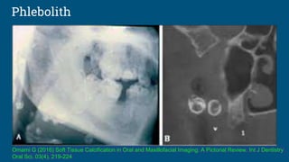 Phlebolith
Omami G (2016) Soft Tissue Calcification in Oral and Maxillofacial Imaging: A Pictorial Review. Int J Dentistry
Oral Sci. 03(4), 219-224
 