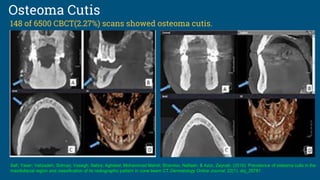 Osteoma Cutis
Safi, Yaser; Valizadeh, Solmaz; Vasegh, Sahra; Aghdasi, Mohammad Mahdi; Shamloo, Nafiseh; & Azizi, Zeynab. (2016). Prevalence of osteoma cutis in the
maxillofacial region and classification of its radiographic pattern in cone beam CT.Dermatology Online Journal, 22(1). doj_29781
148 of 6500 CBCT(2.27%) scans showed osteoma cutis.
 