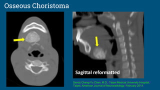 Osseous Choristoma
Sandy Cheng-Yu Chen, M.D., Taipei Medical University Hospital,
Taipei, American Journal of Neuroradiology, February 2014
 