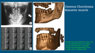 Osseous Choristoma:
Masseter muscle
Priscilla Suassuna Carneiro Lúcio, et al.
An unusual presentation of multiple
osseous choristomas in masseter
muscle. Musculoskelet Regen 2015;
2: e905. doi: 10.14800/mr.905
 