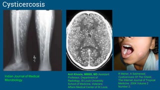 Cysticercosis
Indian Journal of Medical
Microbiology
Anil Khosla, MBBS, MD Assistant
Professor, Department of
Radiology, St Louis University
School of Medicine, Veterans
Affairs Medical Center of St Louis
R Meher, A Sabherwal.
Cysticercosis Of The Cheek.
The Internet Journal of Tropical
Medicine. 2004 Volume 2
Number 2.
 