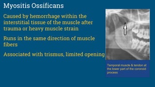 Myositis Ossificans
Temporal muscle & tendon at
the lower part of the coronoid
process
Caused by hemorrhage within the
interstitial tissue of the muscle after
trauma or heavy muscle strain
Runs in the same direction of muscle
fibers
Associated with trismus, limited opening
 