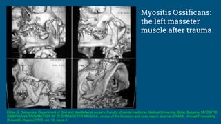 Myositis Ossificans:
the left masseter
muscle after trauma
Elitsa G. Deliverska, Department of Oral and Maxillofacial surgery, Faculty of dental medicine, Medical University, Sofia, Bulgaria, MYOSITIS
OSSIFICANS TRAUMATICA OF THE MASSETER MUSCLE- review of the literature and case report, Journal of IMAB - Annual Proceeding
(Scientific Papers) 2013, vol. 19, issue 4
 