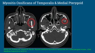 Myositis Ossificans of Temporalis & Medial Pterygoid
Reddy SD, Prakash AP, Keerthi M, Rao BJ. Myositis ossificans traumatica of temporalis and medial pterygoid muscle. J Oral
Maxillofac Pathol 2014;18:271-5
 