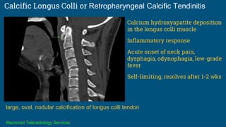 Calcific Longus Colli or Retropharyngeal Calcific Tendinitis
Calcium hydroxyapatite deposition
in the longus colli muscle
Inflammatory response
Acute onset of neck pain,
dysphagia, odynophagia, low-grade
fever
Self-limiting, resolves after 1-2 wks
large, oval, nodular calcification of longus colli tendon
Macrorad Teleradiology Services
 